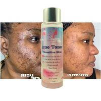 Best Face Toner Effectively Treat Acne Pimples Moisturize Lightening Repair And Soothe Skin Acne Toner